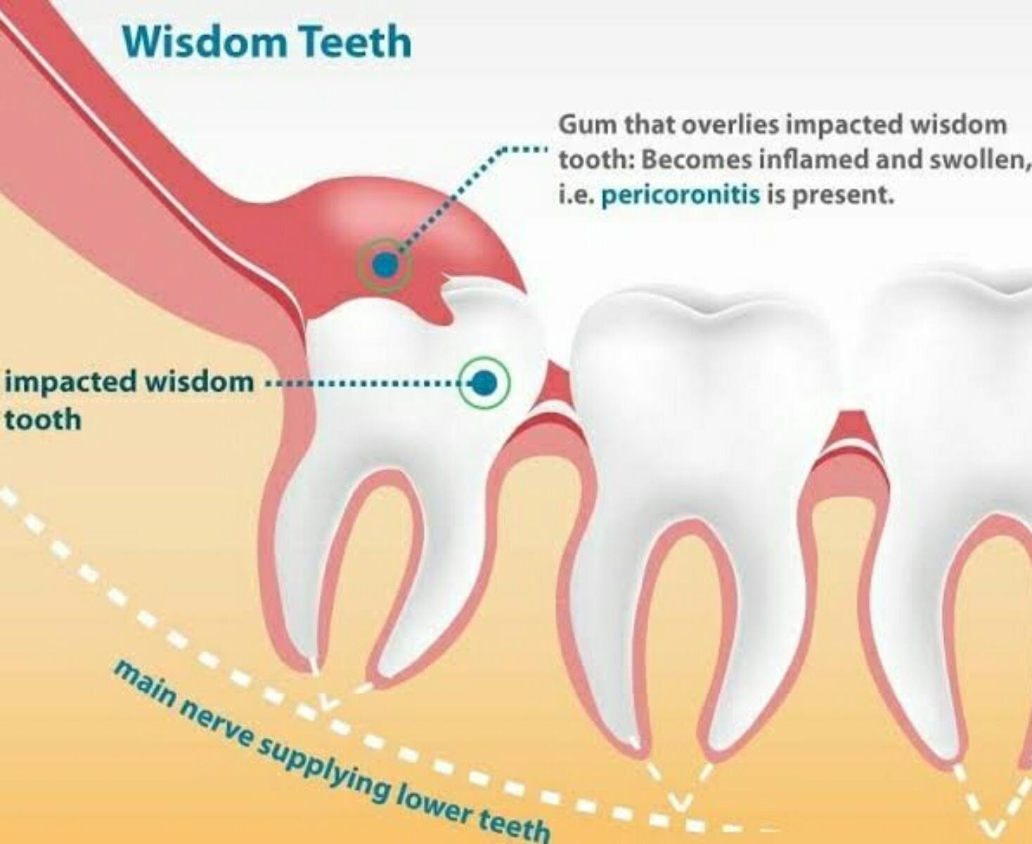 Three reasons why wisdom teeth need to go-