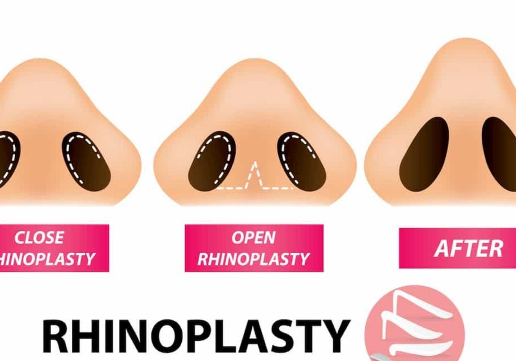 Sushruta’s Rhinoplasty –